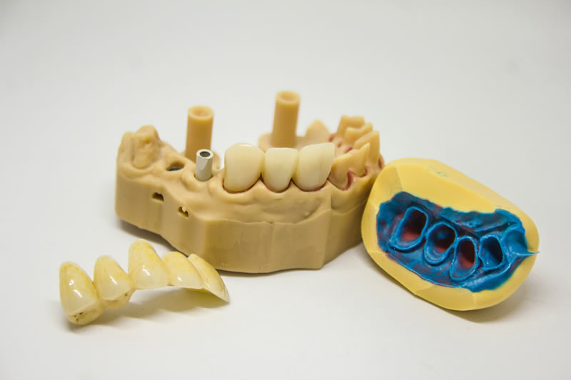 Beispiele von Implantaten